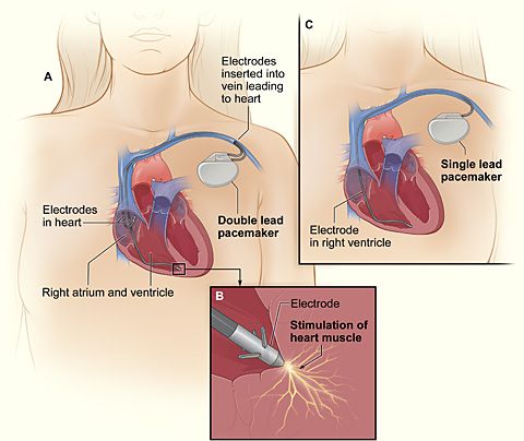stimulateur cardiaque, peut être, cardiaque cardiaque, chirurgie cardiaque