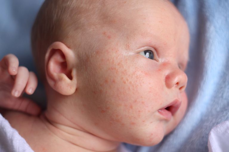 acné infantile, votre bébé, acné bébé, acné votre
