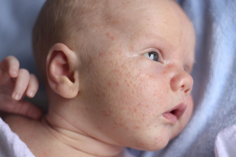 acné bébé, acné nouveau-né, votre bébé, nouveau-né acné, acné chez