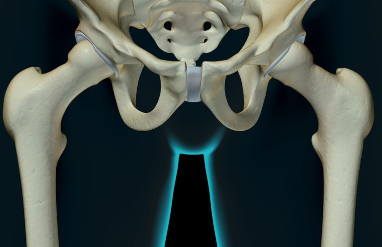 fractures insuffisance, fracture hanche, poids extrémité, acétabulum cavité