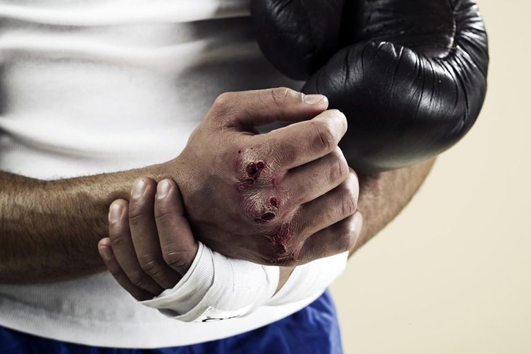 fracture boxeur, après fracture, après fracture boxeur, peut être, dans main, poignet main