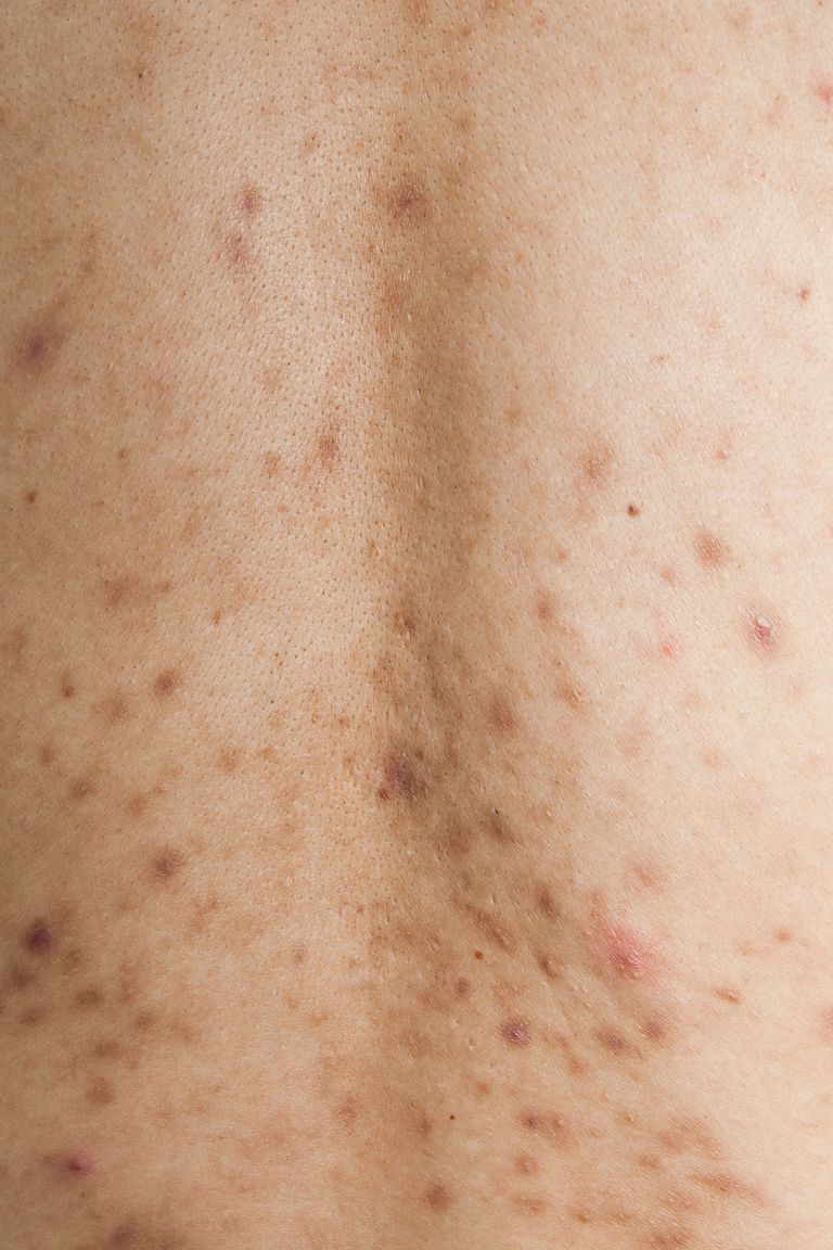 hyperpigmentation post-inflammatoire, votre peau, peuvent être, contre acné