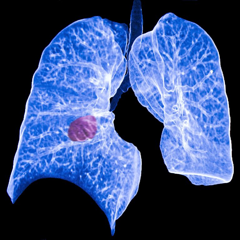 cancer poumon, poumon primaire, cancer poumon primaire, dans poumons, cancer sein