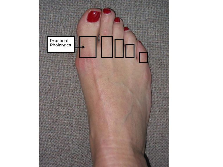 phalange proximale, gros orteil, peut être, phalanges proximales, pieds sont, articulation métatarsophalangienne