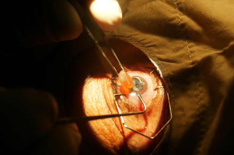 chirurgie cataracte, votre vision, cataracte laser, chirurgie cataracte laser, peut être, vision peut