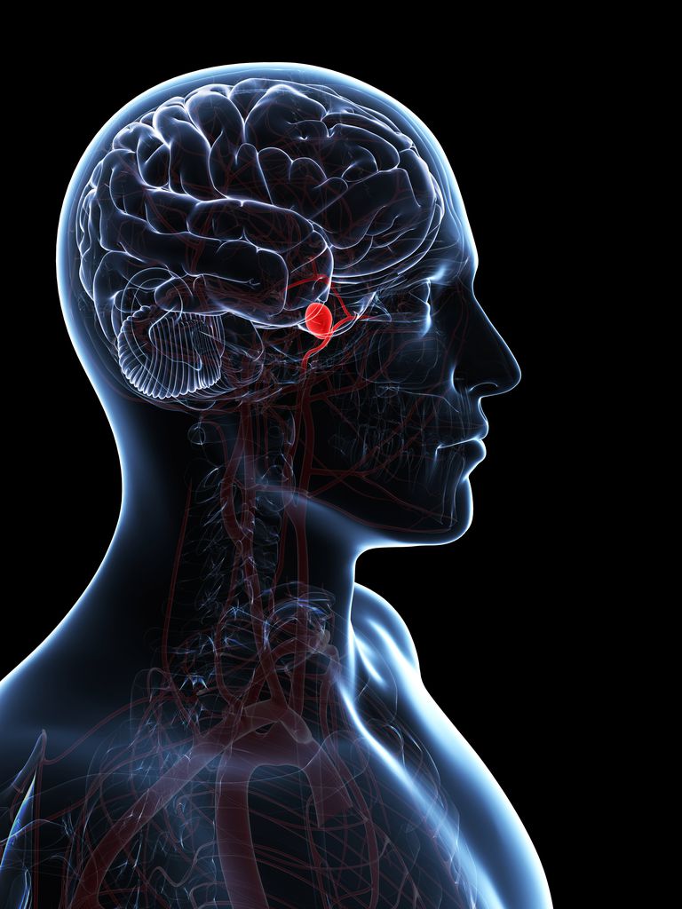 anévrismes cérébraux, maux tête, anévrisme rompu, tissu cérébral, autres facteurs, autres facteurs risque