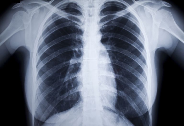 polyarthrite rhumatoïde, maladie pulmonaire, maladie pulmonaire rhumatoïde, pulmonaire rhumatoïde, pulmonaire interstitielle