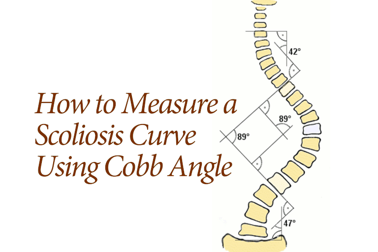 angle Cobb, vertèbre apicale, colonne vertébrale, dans courbe, long bord