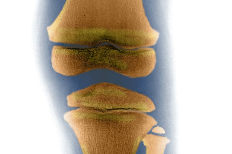 dans arthrose, osseuse sous-chondrale, attrition osseuse, attrition osseuse sous-chondrale, développement arthrose