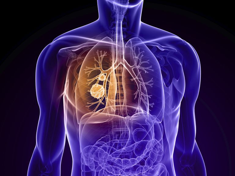 cancer poumon, cancer poumon stade, poumon stade, atteintes cancer, atteintes cancer poumon