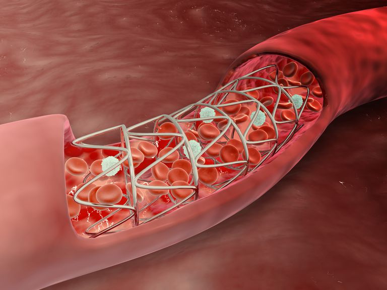 thrombose stent, avec stents, dans artère, Lisez propos, après angioplastie, artères coronaires