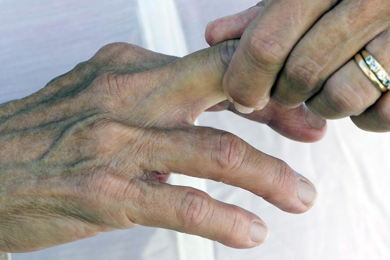 doigt coincé, blessure mineure, chiropraticien ostéopathe, doigt doigt