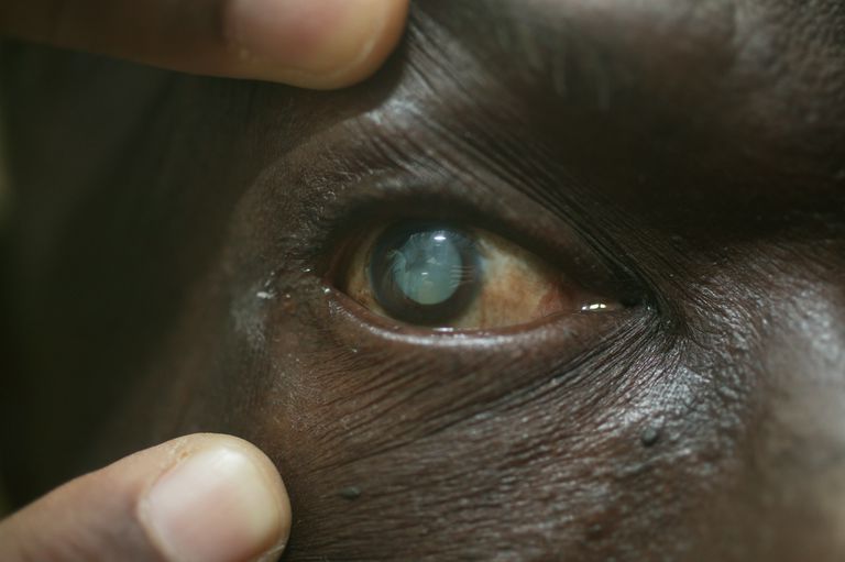 acuité visuelle, diagnostiquer cataractes, pour diagnostiquer, test acuité