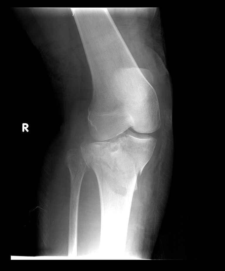 plateau tibial, peut être, articulation genou, fractures déplacées, fractures plateau, peuvent être