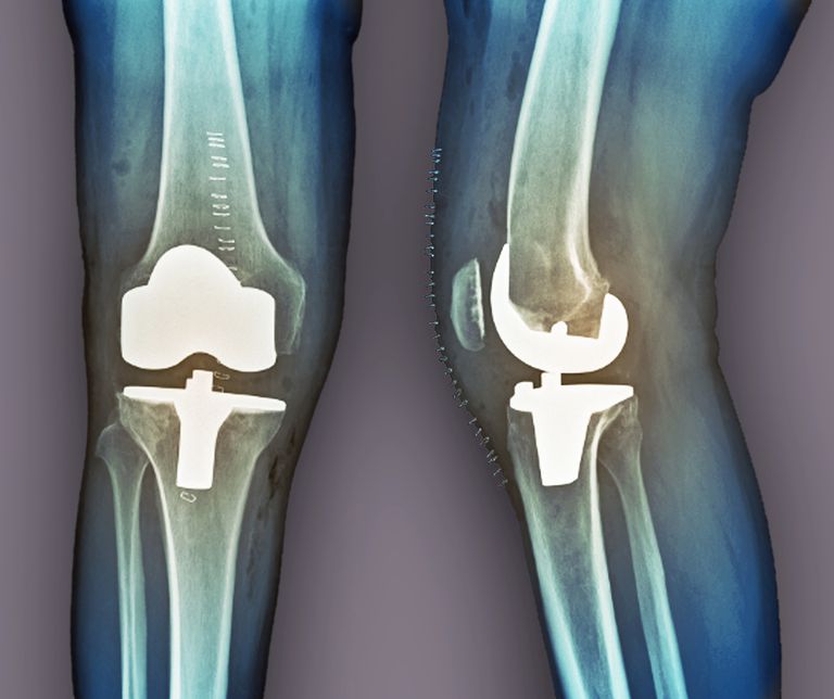 partiel genou, remplacement partiel, remplacement partiel genou, arthroplastie totale
