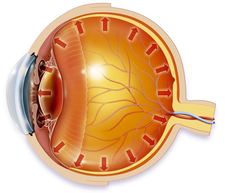 pression oculaire, après chirurgie, canal drainage, chirurgie trabéculectomie, chirurgie laser, drainage crée