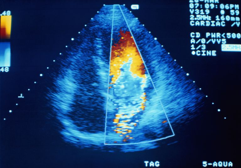 échocardiogramme standard, ondes sonores, peut être, votre cœur, directement derrière