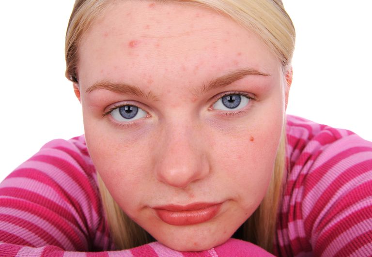 acné légère, votre peau, traiter acné, votre acné, est-ce acné, points noirs