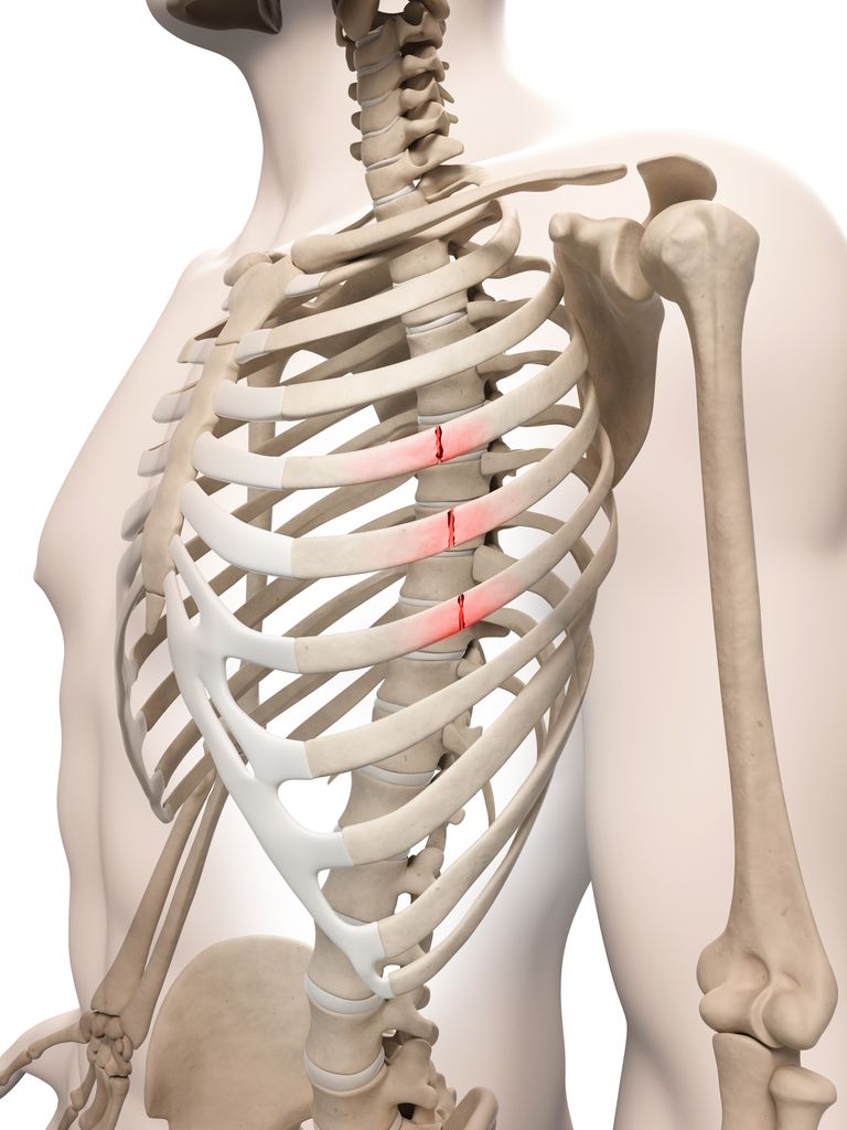 fractures côtes, côtes sont, fractures côtes sont, côtes sont traitées, fracture côte, fracture côtes