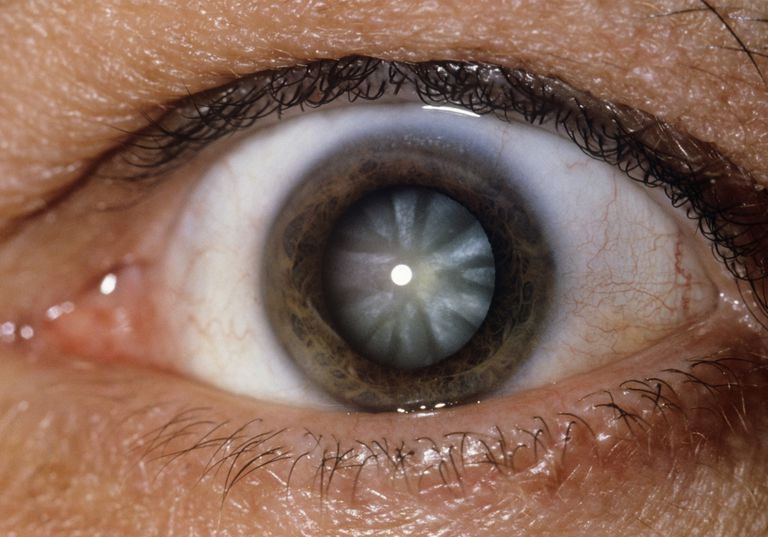 cataractes peuvent, peuvent développer, type cataracte, cataracte provoque, cataractes fonction