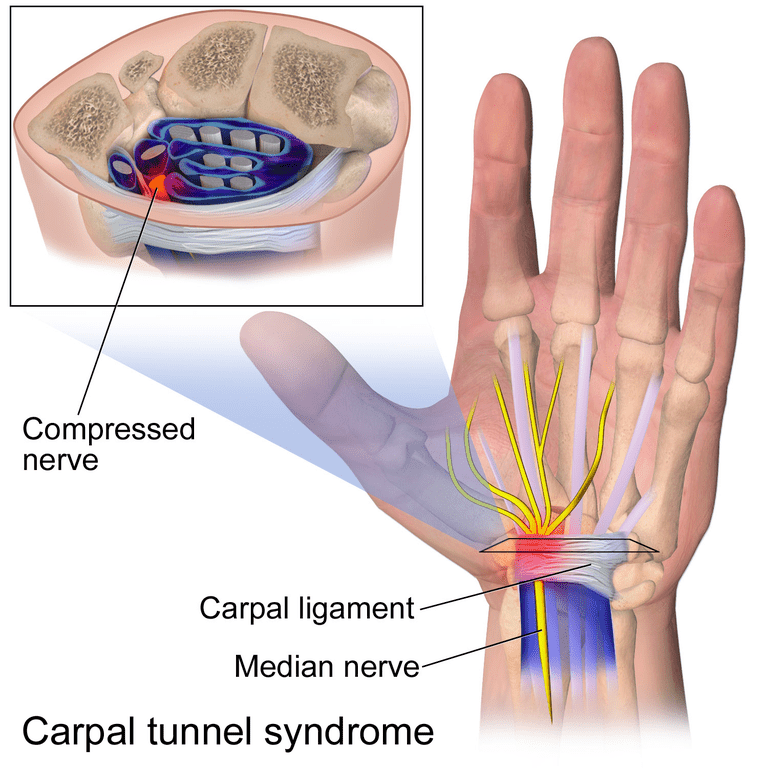 canal carpien, syndrome canal, syndrome canal carpien, nerf médian, peuvent être