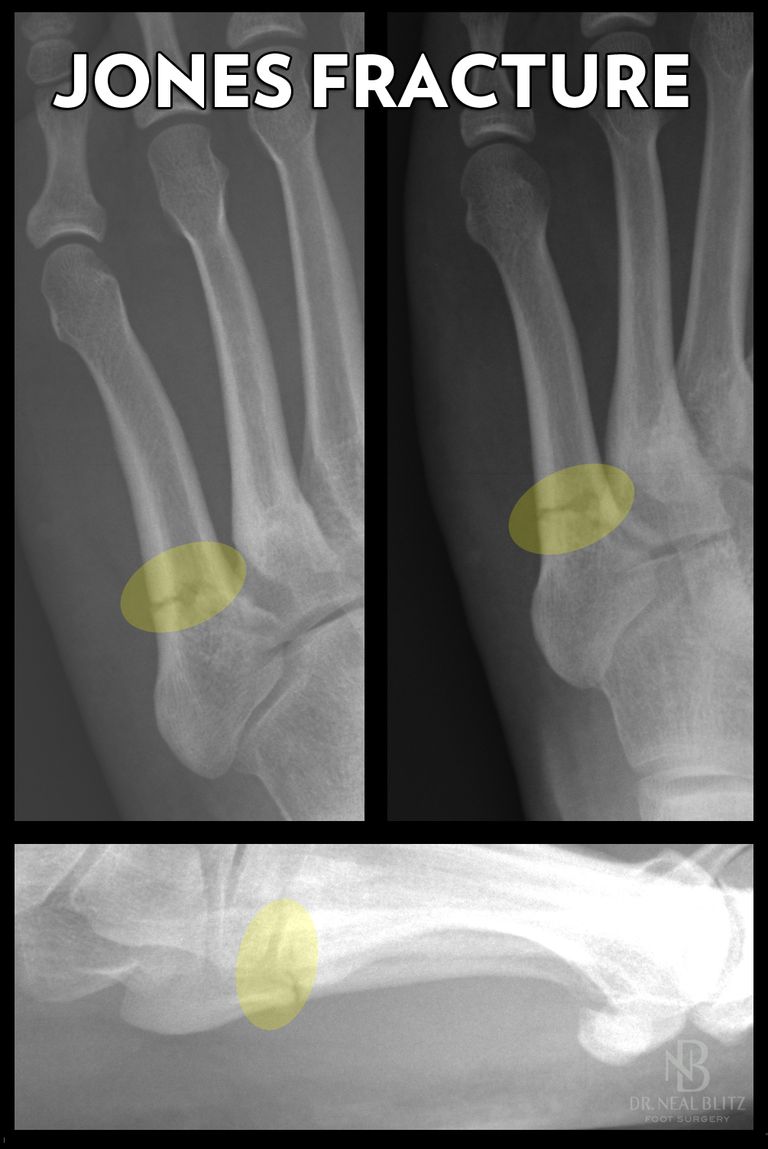 fractures Jones, fracture Jones, cicatrisation osseuse, dans zone, fractures Jones Fract