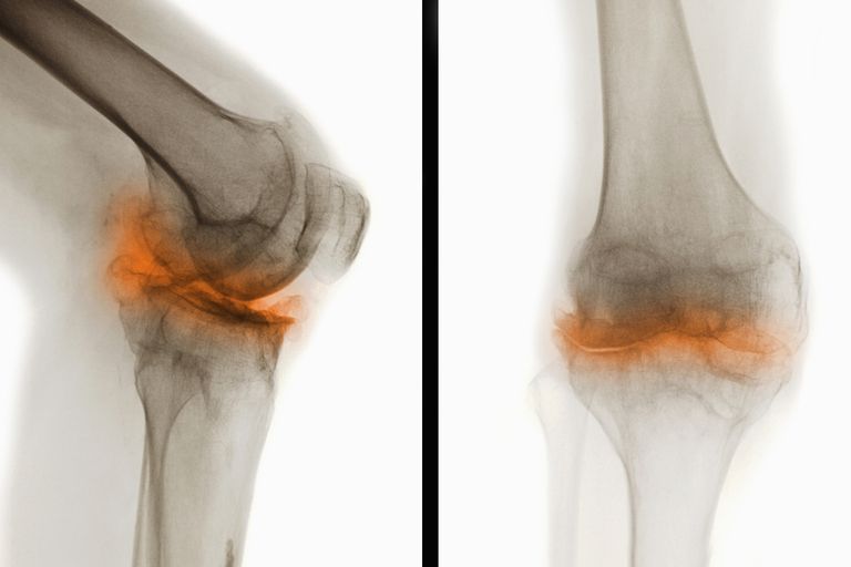 arthrose genou, votre médecin, orthèse genou, orthèses genou, genouillère déchargeuse, pour arthrose