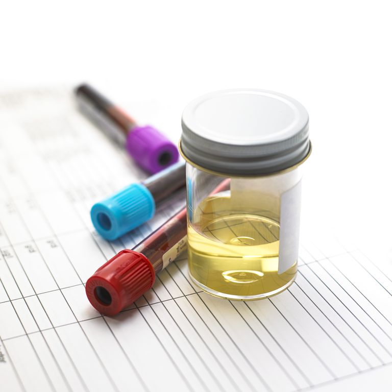 tests urine, chlamydia gonorrhée, échantillons urine, gonorrhée chlamydia, urine pour