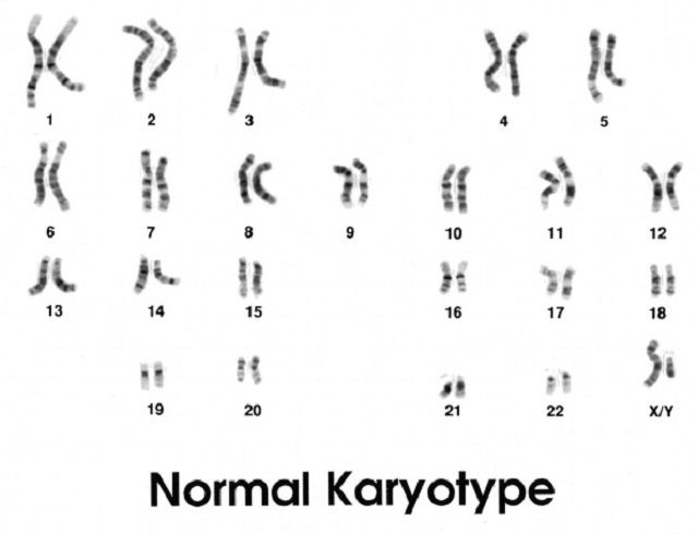 syndrome Down, syndrome syndrome, caryotype peut, caryotype révèle, chromosomes sont, condition causée