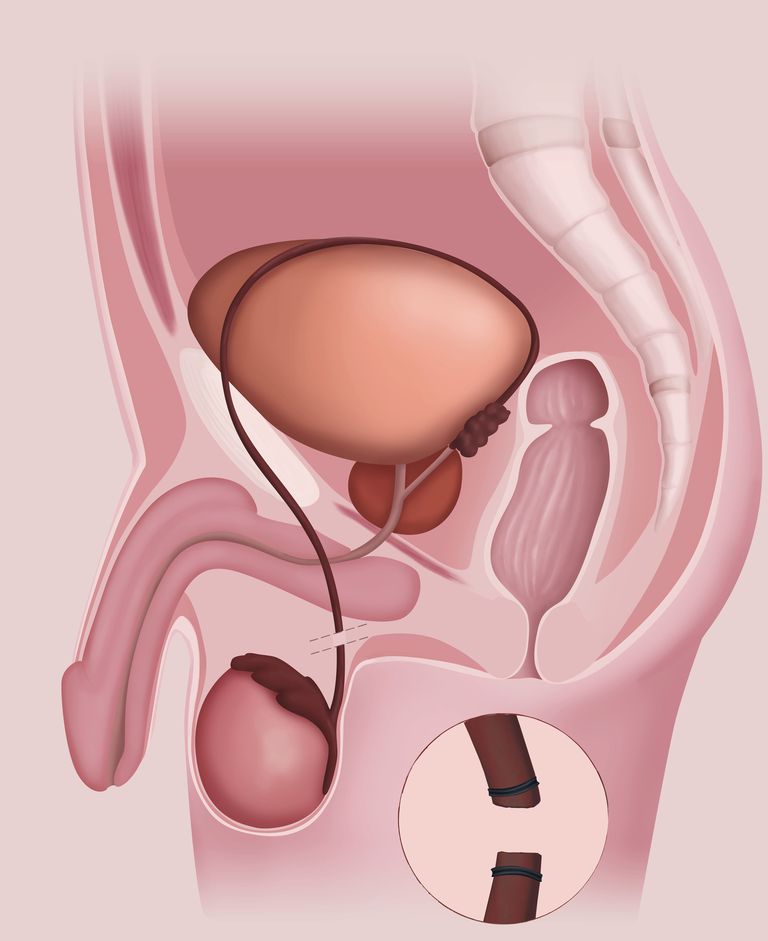 canal déférent, après vasectomie, échantillon sperme, peut être, contrôle naissances