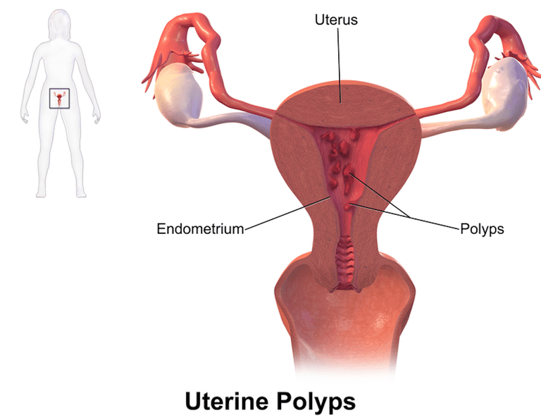 polypes utérins, dans utérus, leurs polypes, pour cent, symptômes polypes