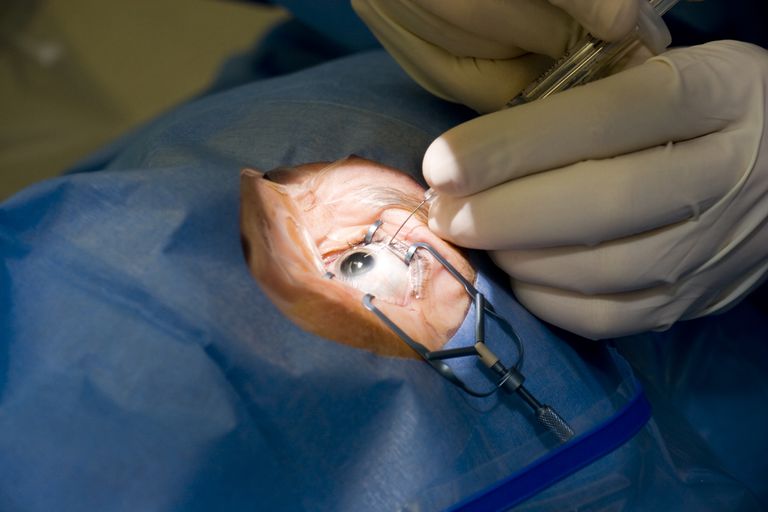 peuvent être, cataractes développent, chirurgie cataracte, diagnostic cataracte, peut devenir