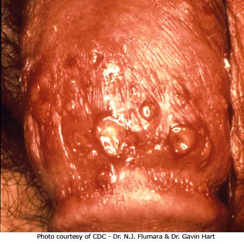 virus herpès, Cette image montre, herpès génital, herpès simplex, image montre