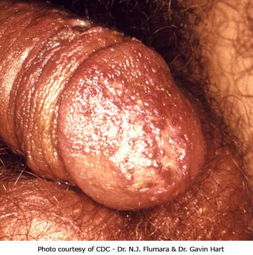 virus herpès, Cette image montre, herpès génital, herpès simplex, image montre