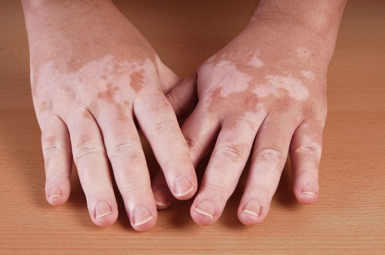 zones touchées, atteints vitiligo, maladie thyroïdienne, maladie thyroïdienne auto-immune, maladies auto-immunes