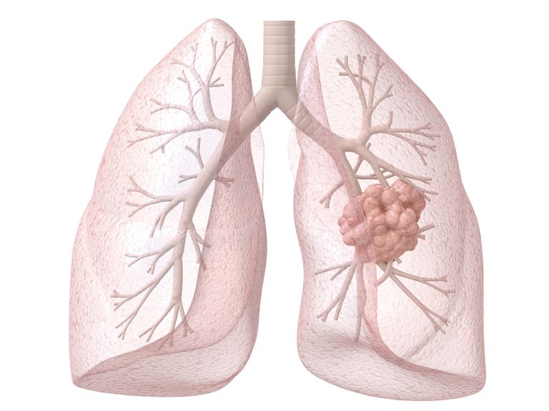 cancer poumon, poumon chez, chez hommes, petites cellules