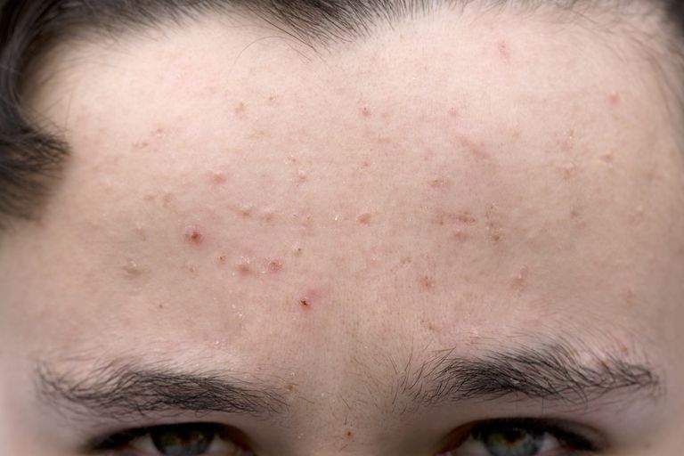 acné modérée, votre peau, vous avez, points noirs