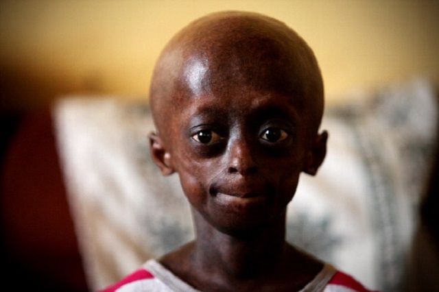 syndrome Werner, enfants atteints, atteints progeria, enfants atteints progeria, personnes atteintes
