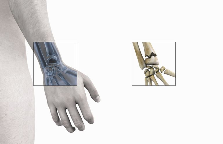 articulation poignet, fracture Smith, avant-bras radius, avec main
