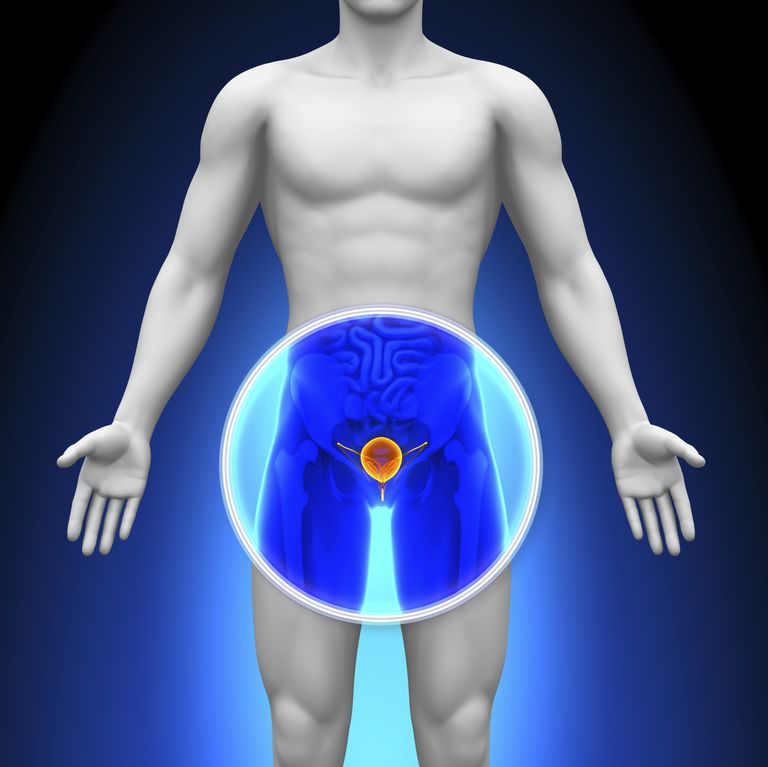cancer prostate, peut être, stade précoce, avec cancer, cancer prostate stade